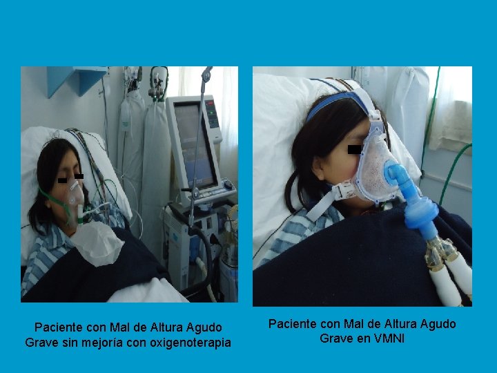 Paciente con Mal de Altura Agudo Grave sin mejoría con oxigenoterapia Paciente con Mal