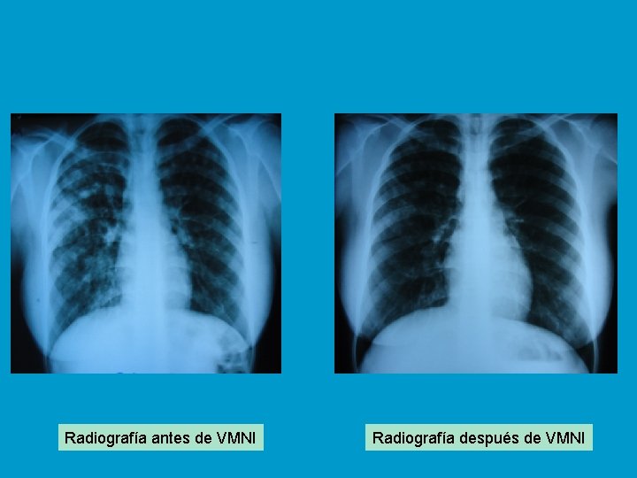 Radiografía antes de VMNI Radiografía después de VMNI 