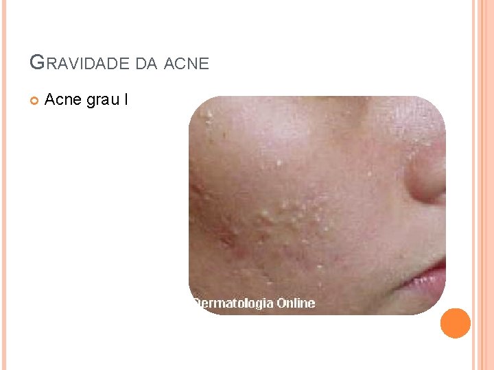 GRAVIDADE DA ACNE Acne grau I 