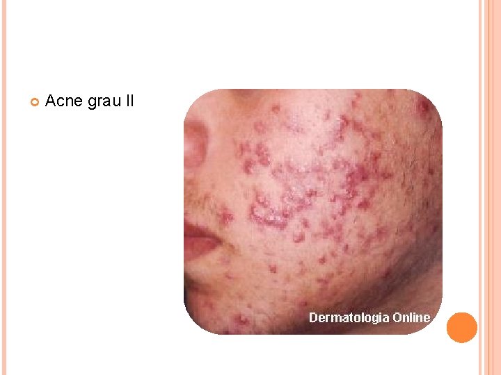  Acne grau II 