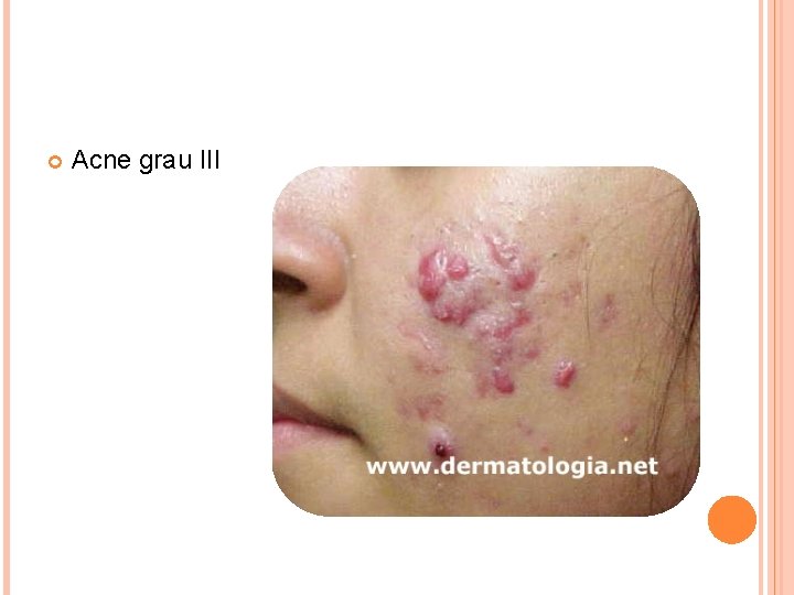  Acne grau III 