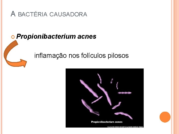 A BACTÉRIA CAUSADORA Propionibacterium acnes inflamação nos folículos pilosos 