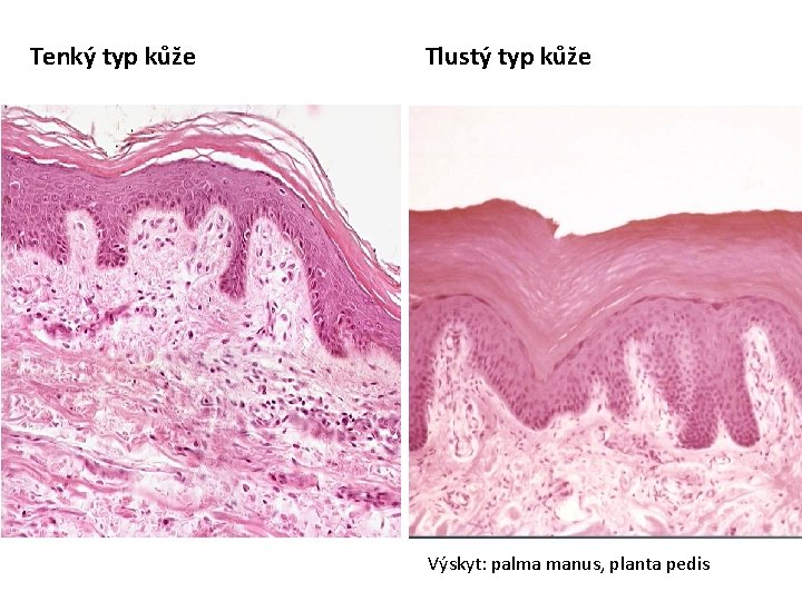 Tenký typ kůže Tlustý typ kůže Výskyt: palma manus, planta pedis 