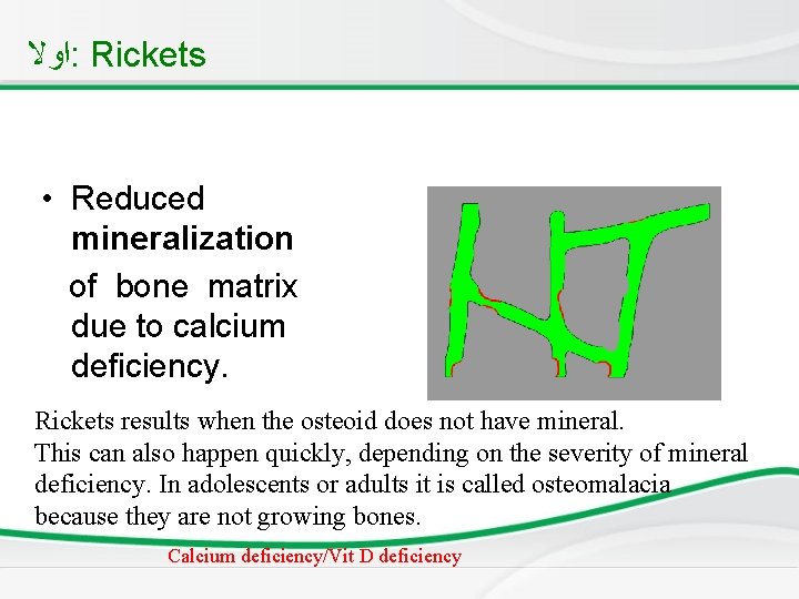  ﺍﻭﻻ : Rickets • Reduced mineralization of bone matrix due to calcium deficiency.