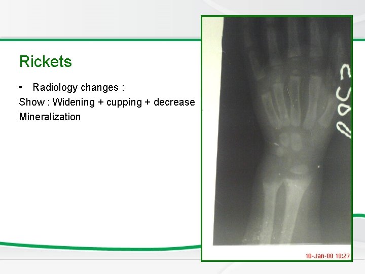 Newborn Screening Rickets • Radiology changes : Show : Widening + cupping + decrease