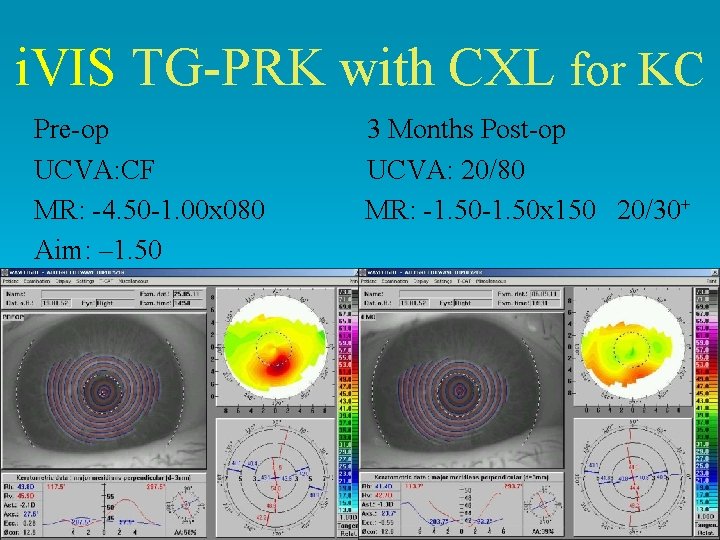 i. VIS TG-PRK with CXL for KC Pre-op UCVA: CF MR: -4. 50 -1. i. VIS TG-PRK with CXL for KC Pre-op UCVA: CF MR: -4. 50 -1.