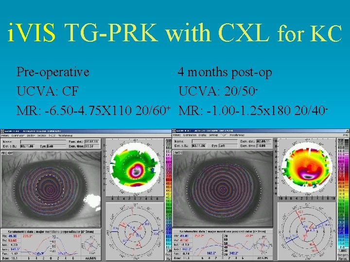 i. VIS TG-PRK with CXL for KC Pre-operative 4 months post-op UCVA: CF UCVA: i. VIS TG-PRK with CXL for KC Pre-operative 4 months post-op UCVA: CF UCVA: