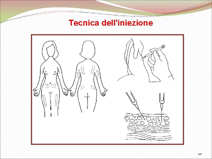 Tecnica dell'iniezione 20 Tecnica dell'iniezione 20