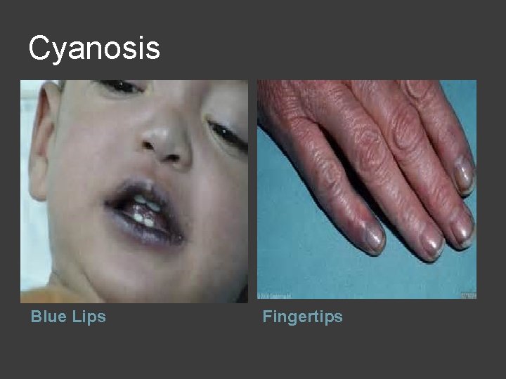 Cyanosis Blue Lips Fingertips 