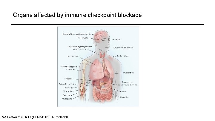 Organs affected by immune checkpoint blockade MA Postow et al. N Engl J Med