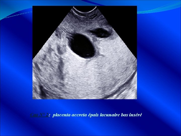 Cas N° 2: placenta accreta épais lacunaire bas inséré 