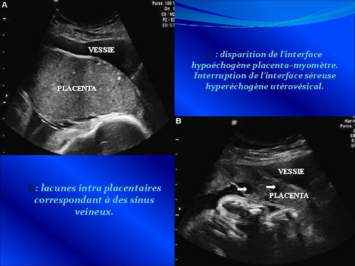 A : disparition de l’interface hypoéchogène placenta–myomètre. Interruption de l’interface séreuse hyperéchogène utérovésical. B