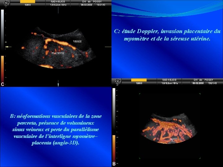 C: étude Doppler, invasion placentaire du myomètre et de la séreuse utérine. B: néoformations