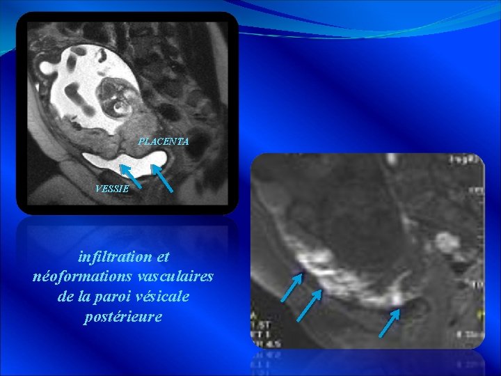 PLACENTA VESSIE infiltration et néoformations vasculaires de la paroi vésicale postérieure 
