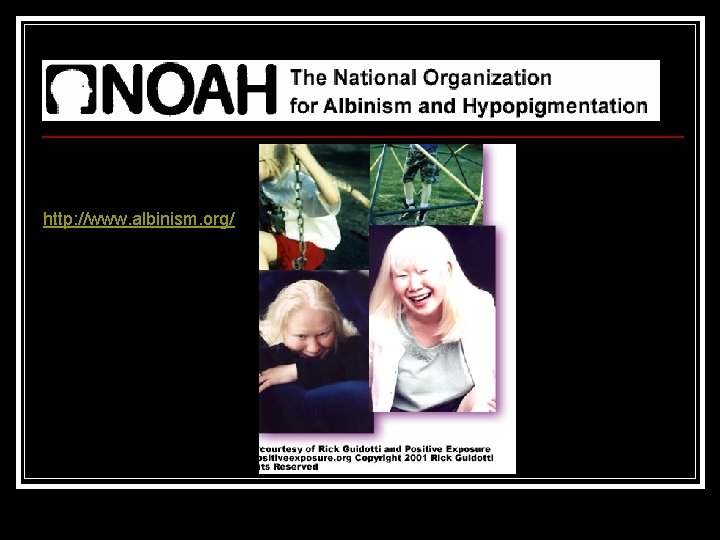 http: //www. albinism. org/ 