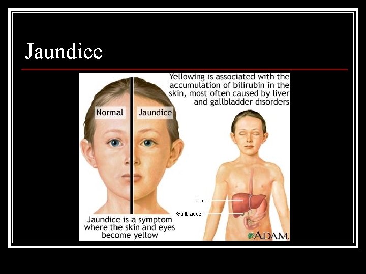 Jaundice 