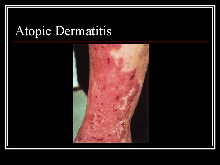 Atopic Dermatitis 