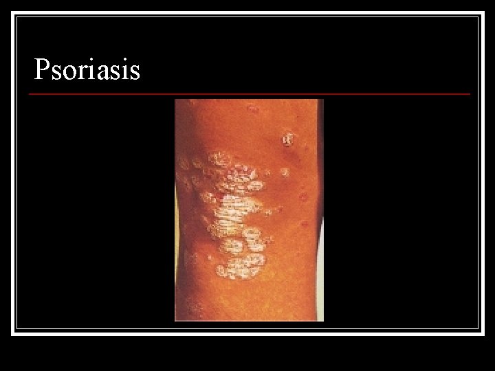 Psoriasis 