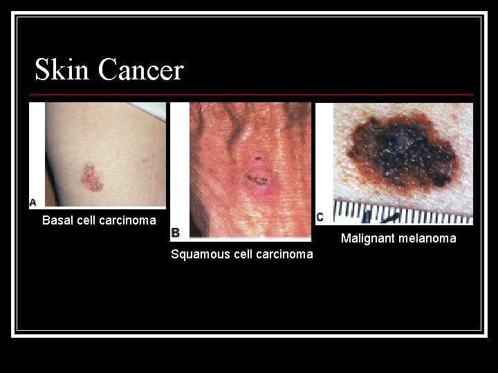 Skin Cancer Basal cell carcinoma Malignant melanoma Squamous cell carcinoma 