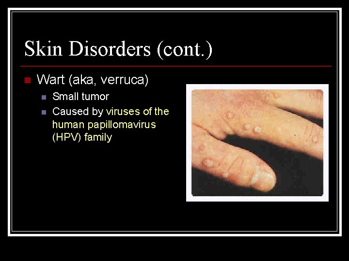 Skin Disorders (cont. ) n Wart (aka, verruca) n n Small tumor Caused by