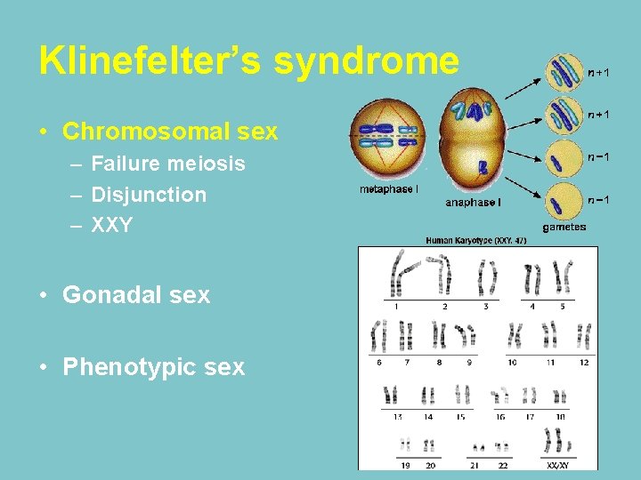 Klinefelter’s syndrome • Chromosomal sex – Failure meiosis – Disjunction – XXY • Gonadal Klinefelter’s syndrome • Chromosomal sex – Failure meiosis – Disjunction – XXY • Gonadal