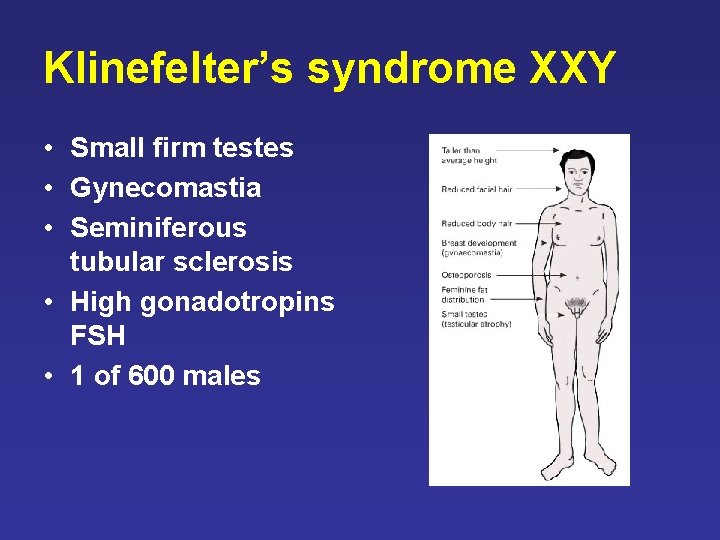 Klinefelter’s syndrome XXY • Small firm testes • Gynecomastia • Seminiferous tubular sclerosis • Klinefelter’s syndrome XXY • Small firm testes • Gynecomastia • Seminiferous tubular sclerosis •