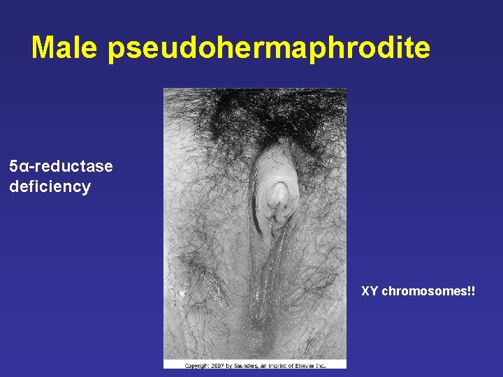Male pseudohermaphrodite 5α-reductase deficiency XY chromosomes!! Male pseudohermaphrodite 5α-reductase deficiency XY chromosomes!!