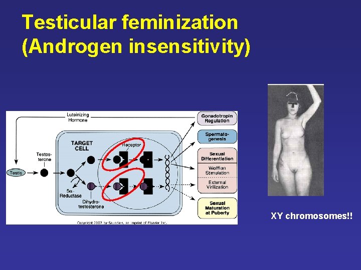 Testicular feminization (Androgen insensitivity) XY chromosomes!! Testicular feminization (Androgen insensitivity) XY chromosomes!!