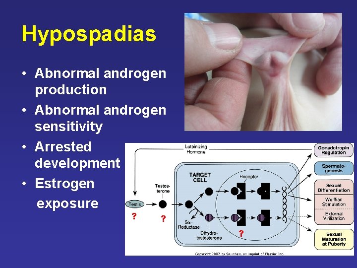 Hypospadias • Abnormal androgen production • Abnormal androgen sensitivity • Arrested development • Estrogen Hypospadias • Abnormal androgen production • Abnormal androgen sensitivity • Arrested development • Estrogen