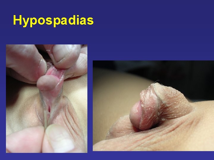 Hypospadias Hypospadias