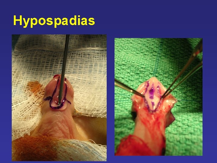 Hypospadias Hypospadias