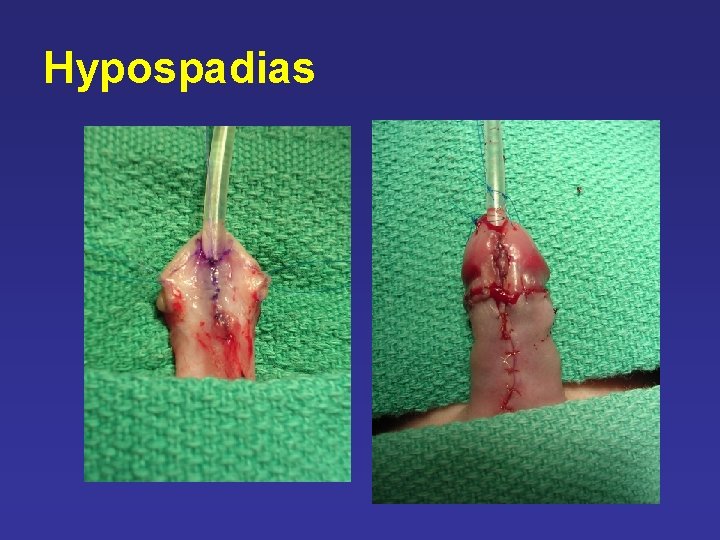Hypospadias Hypospadias