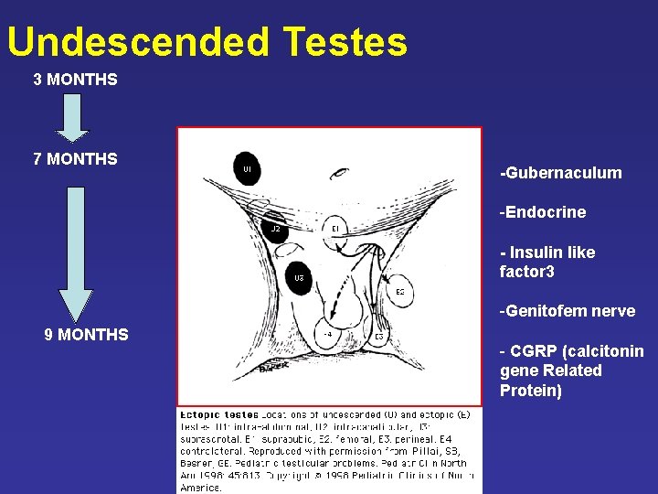 Undescended Testes 3 MONTHS 7 MONTHS -Gubernaculum -Endocrine - Insulin like factor 3 -Genitofem Undescended Testes 3 MONTHS 7 MONTHS -Gubernaculum -Endocrine - Insulin like factor 3 -Genitofem