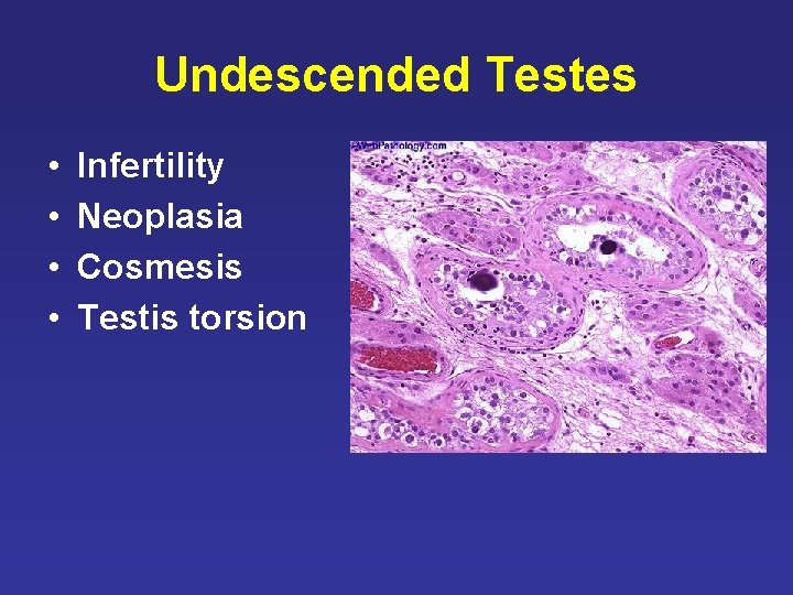 Undescended Testes • • Infertility Neoplasia Cosmesis Testis torsion Undescended Testes • • Infertility Neoplasia Cosmesis Testis torsion
