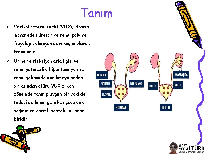 Tanım Ø Vezikoüreteral reflü (VUR), idrarın mesaneden üreter ve renal pelvise fizyolojik olmayan geri