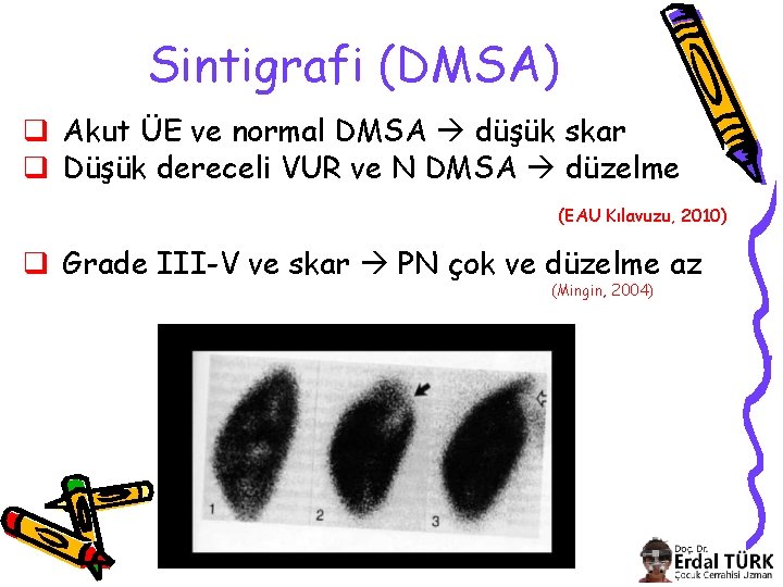 Sintigrafi (DMSA) q Akut ÜE ve normal DMSA düşük skar q Düşük dereceli VUR