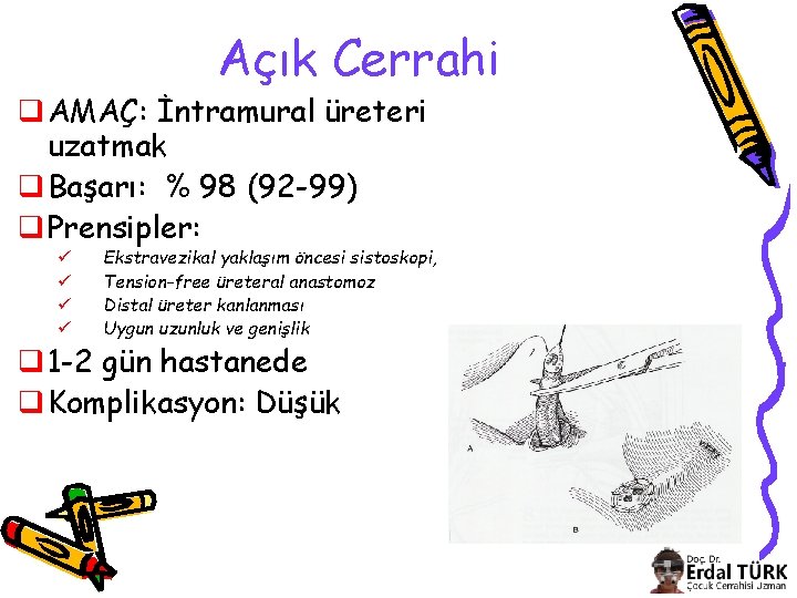 Açık Cerrahi q AMAÇ: İntramural üreteri uzatmak q Başarı: % 98 (92 -99) q