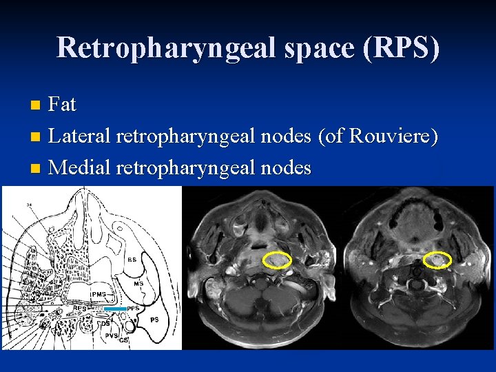 Retropharyngeal space (RPS) Fat n Lateral retropharyngeal nodes (of Rouviere) n Medial retropharyngeal nodes