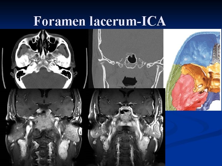 Foramen lacerum-ICA 