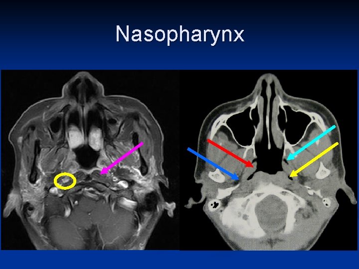 Nasopharynx 