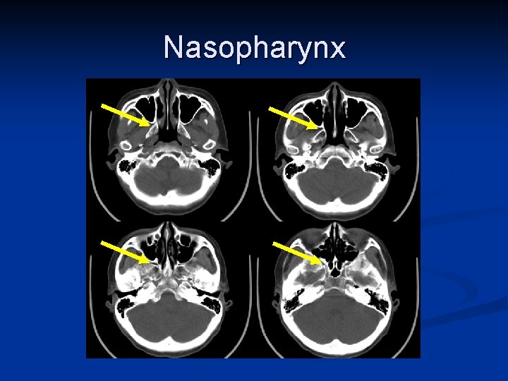 Nasopharynx 