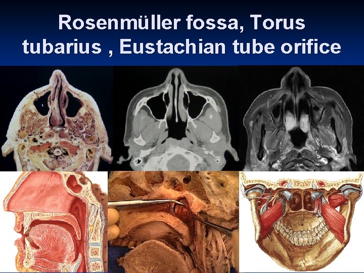 Rosenmüller fossa, Torus tubarius , Eustachian tube orifice 