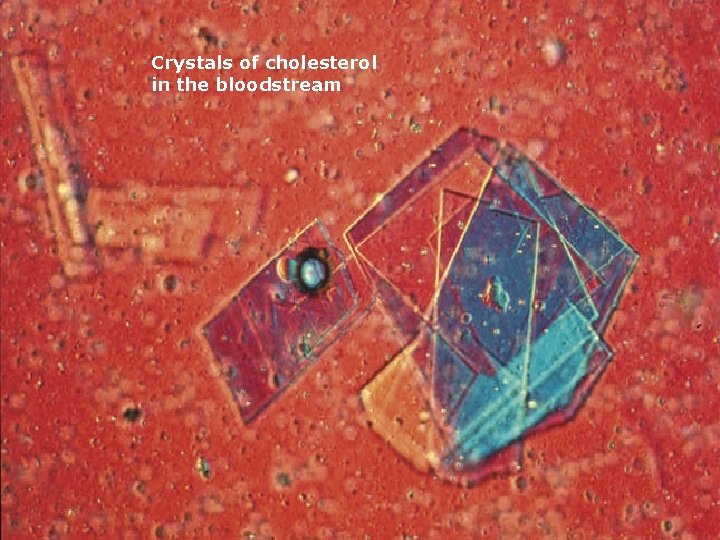 Crystals of cholesterol in the bloodstream 