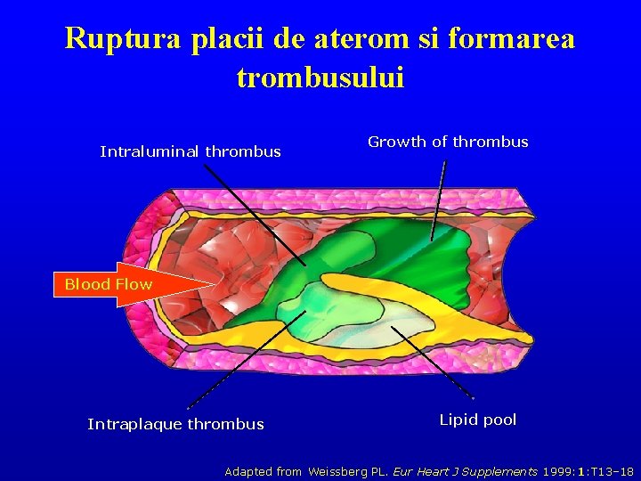 Ruptura placii de aterom si formarea trombusului Intraluminal thrombus Growth of thrombus Blood Flow