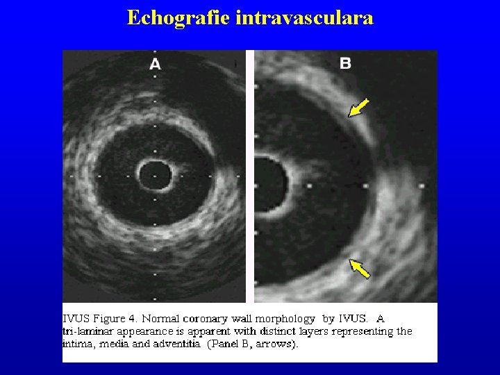 Echografie intravasculara 