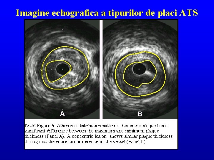 Imagine echografica a tipurilor de placi ATS 
