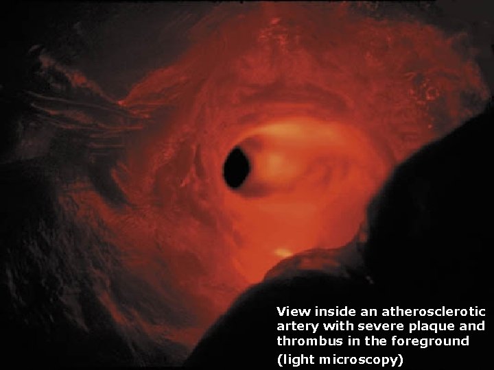 View inside an atherosclerotic artery with severe plaque and thrombus in the foreground (light