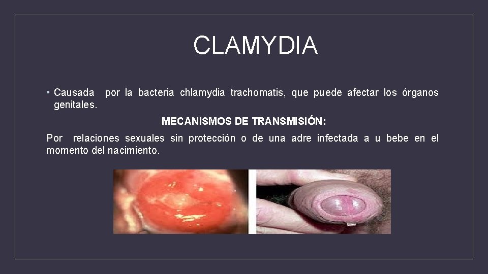 CLAMYDIA • Causada por la bacteria chlamydia trachomatis, que puede afectar los órganos genitales.