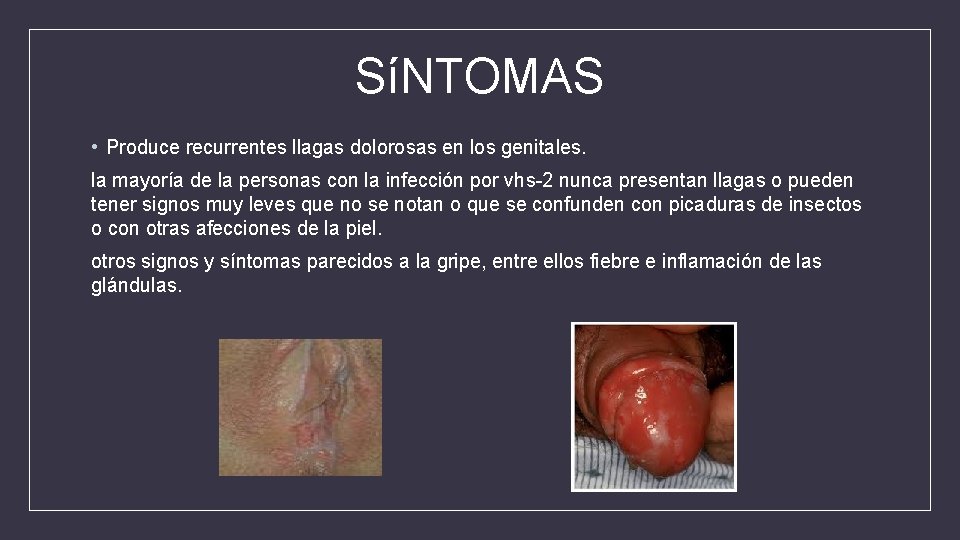 SíNTOMAS • Produce recurrentes llagas dolorosas en los genitales. la mayoría de la personas