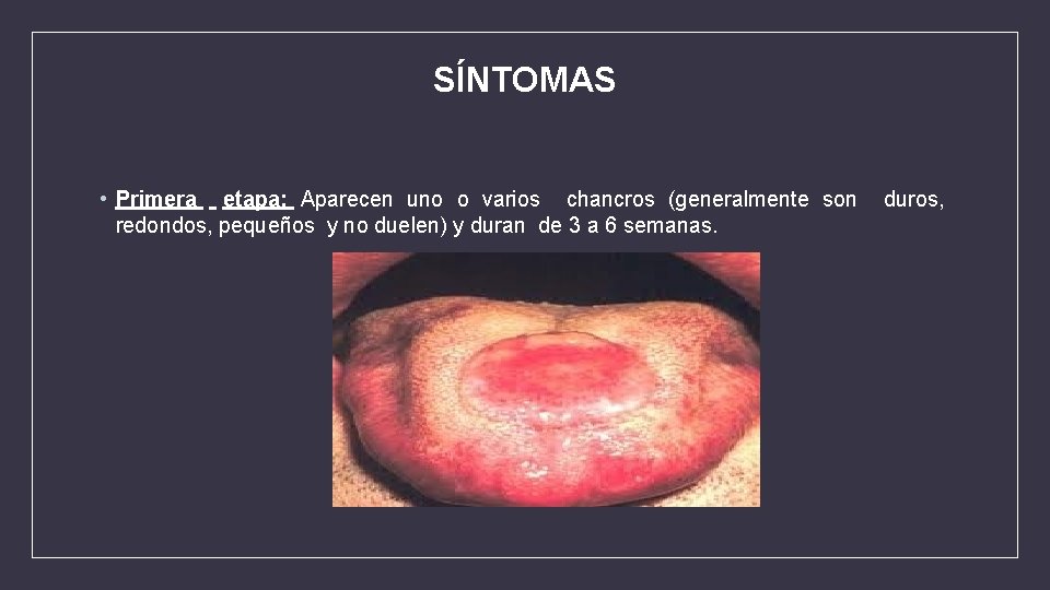 SÍNTOMAS • Primera etapa: Aparecen uno o varios chancros (generalmente son duros, redondos, pequeños